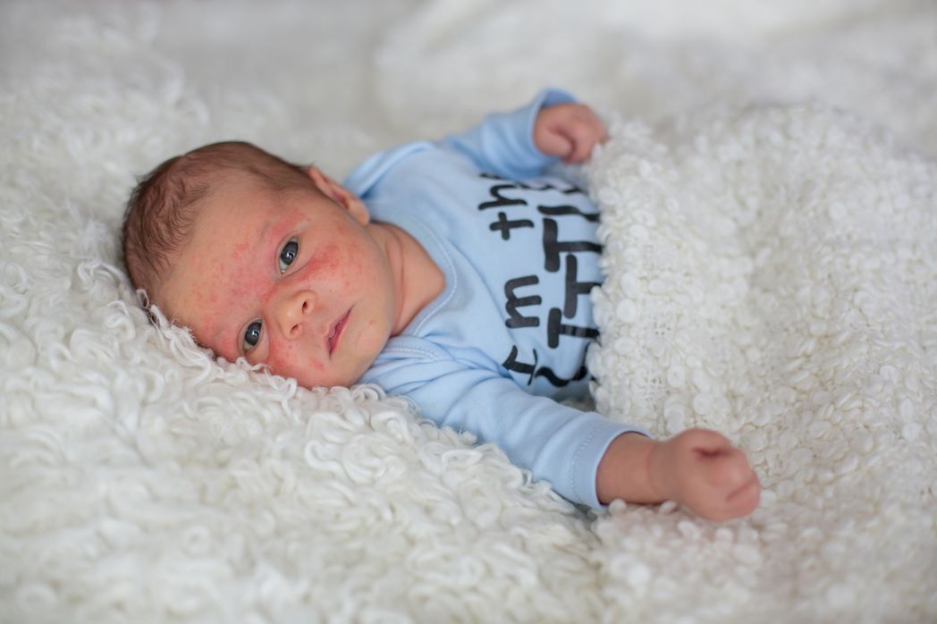 A newborn baby with eczema and skin issues.