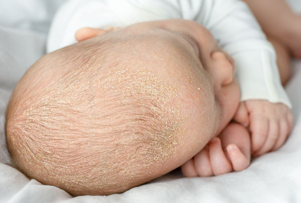 A baby's scalp showing cradle cap flakes.